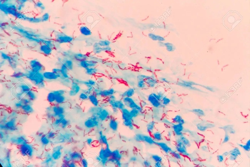 Микобактерии туберкулеза (палочки Коха) под микроскопом, окрашивание по Цилю-Нильсену (извините за идиота из фотобанки, хороших картиночек сейчас не купишь :С)