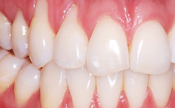 Что можно поменять в дёснах (правда, цена операции — 2 месяца смузи-диеты) - 4 Что можно поменять в дёснах (правда, цена операции — 2 месяца смузи-диеты) - 4