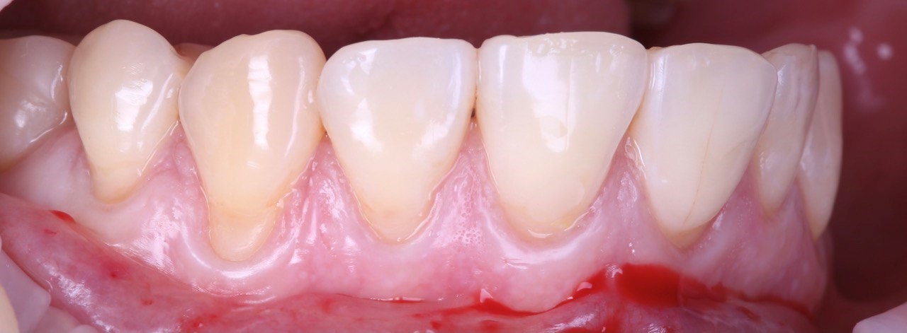Что можно поменять в дёснах (правда, цена операции — 2 месяца смузи-диеты) - 6 Что можно поменять в дёснах (правда, цена операции — 2 месяца смузи-диеты) - 6