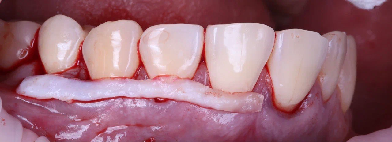 Что можно поменять в дёснах (правда, цена операции — 2 месяца смузи-диеты) - 7 Что можно поменять в дёснах (правда, цена операции — 2 месяца смузи-диеты) - 7