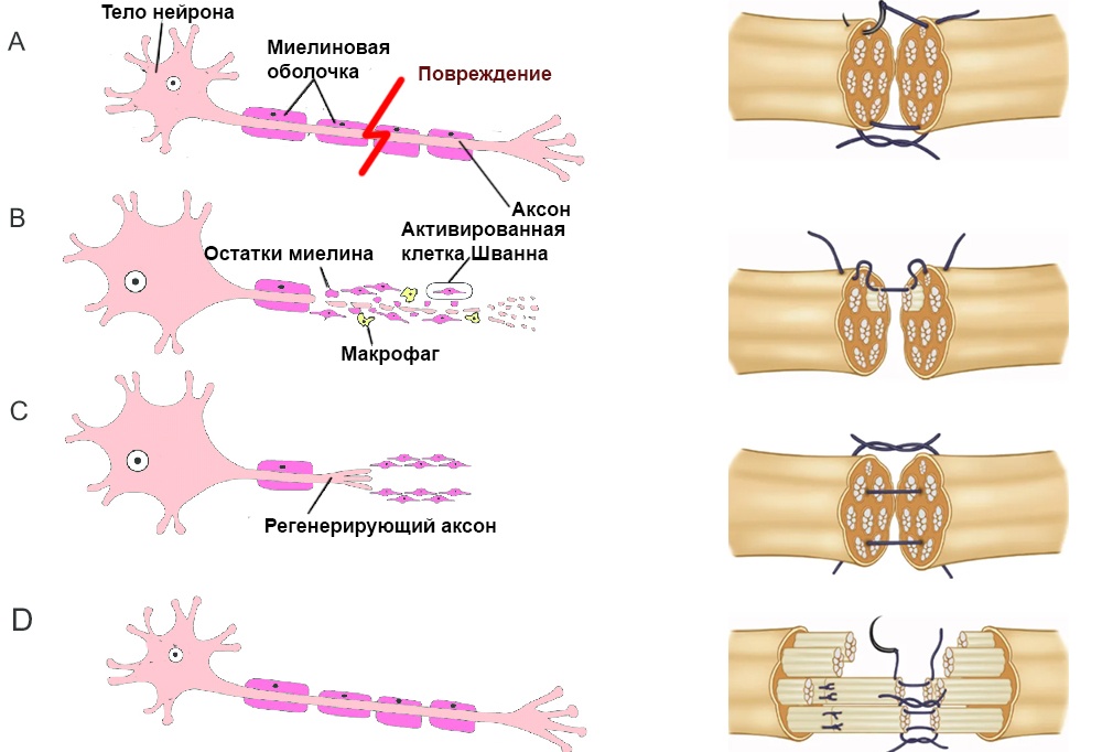 Общая схема регенерации аксонов при повреждении (слева) и различные способы сшивания нервов и их отдельных пучков (справа)