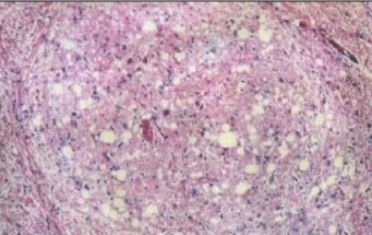 Гистологический срез головного мозга страдавшего от болезнивзрослого мужчины, который впоследствии погиб от куру Гистологический срез головного мозга страдавшего от болезнивзрослого мужчины, который впоследствии погиб от куру