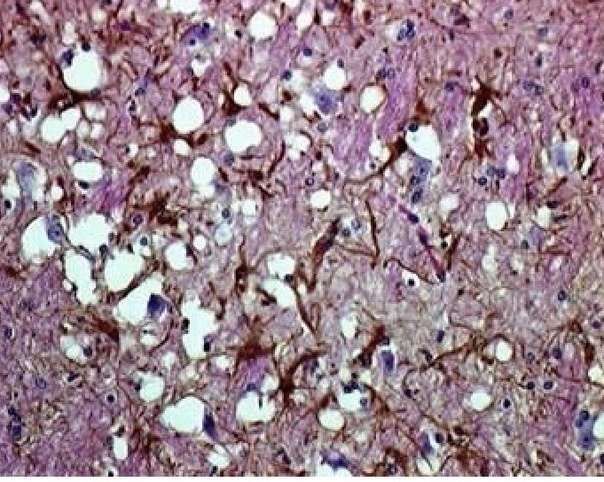 Гистологические измнения головного мозга овцы павшей от скрепи Гистологические измнения головного мозга овцы павшей от скрепи