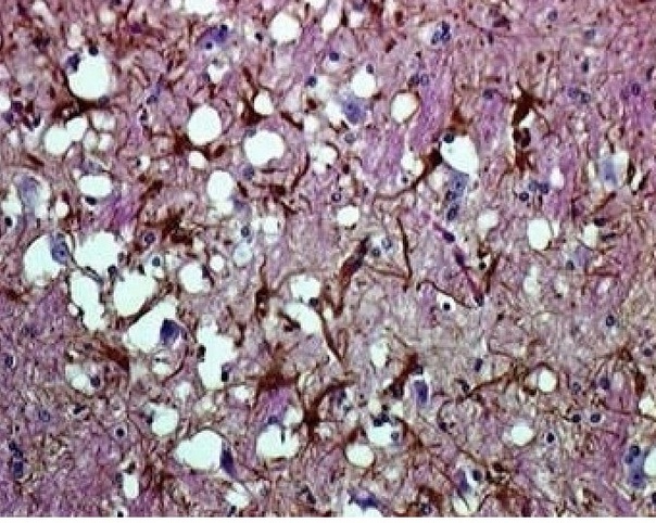 Гистологические измнения головного мозга овцы павшей от скрепи
