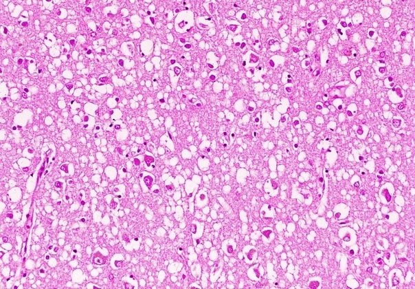 Гистологическая картина болезни Кройтцфельда-Якоба Гистологическая картина болезни Кройтцфельда-Якоба