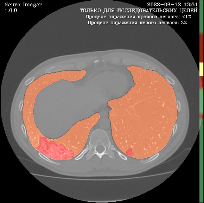 На исходный снимок нанесены маски здоровой паренхимы лёгких — оранжевого цвета. Красный цвет — у участков с признаками патологических изменений, вызванных COVID-19. Система также рассчитала проценты поражения каждого из лёгких