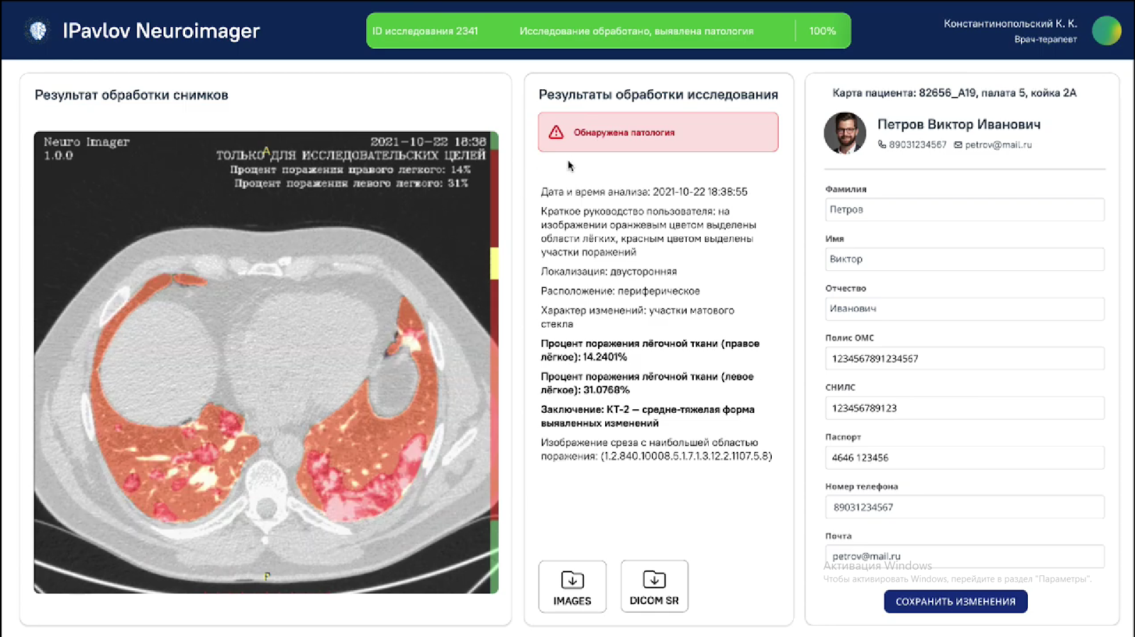 iPavlov CDSS Neuro-Imager распознает патологические образования по цифровым снимкам КТ/НДКТ ОГК, МРТ, ММГ и РГ/ФЛГ. В случае превышения заранее заданных критических значений система подает врачу сигнал о возможной патологии