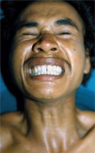 Risus sardonicus — сардоническая улыбка Risus sardonicus — сардоническая улыбка