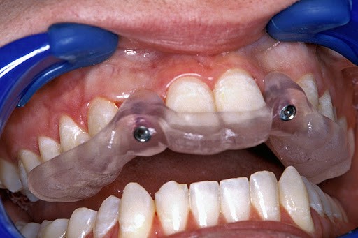 Как 3D-принтеры захватывают стоматологию и почему это прекрасно - 16