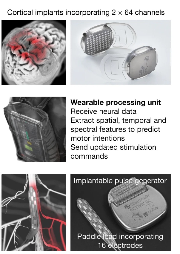 Кортикальный имплантат состоит из 2 блоков по 64 электрода. Носимый процессор выступает электрическими мозгами системы. Многие сложные процедуры обработки данных выполняются именно этой частью нейроимплантата.