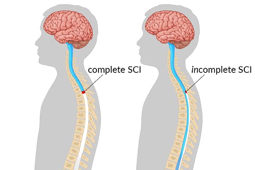 Слева изображена принципиальная схема полного перерыва спинного мозга. Справа — состояние, при котором проводящие пути частично сохранили свою целостность.