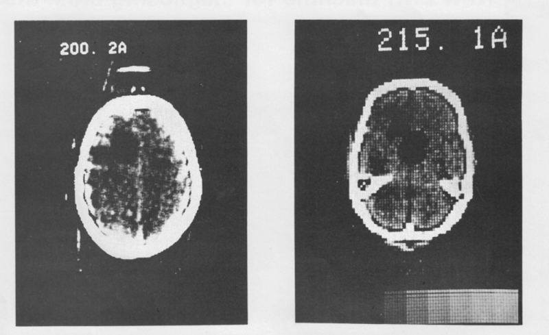 Снимки, полученные при первой компьютерной томографии