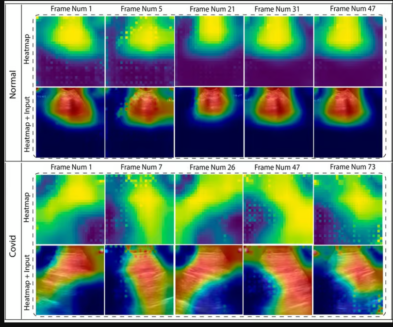 Новый искусственный интеллект распознает 97% заболеваний легких и может отличить пневмонию от COVID-19 - 2 Новый искусственный интеллект распознает 97% заболеваний легких и может отличить пневмонию от COVID-19 - 2