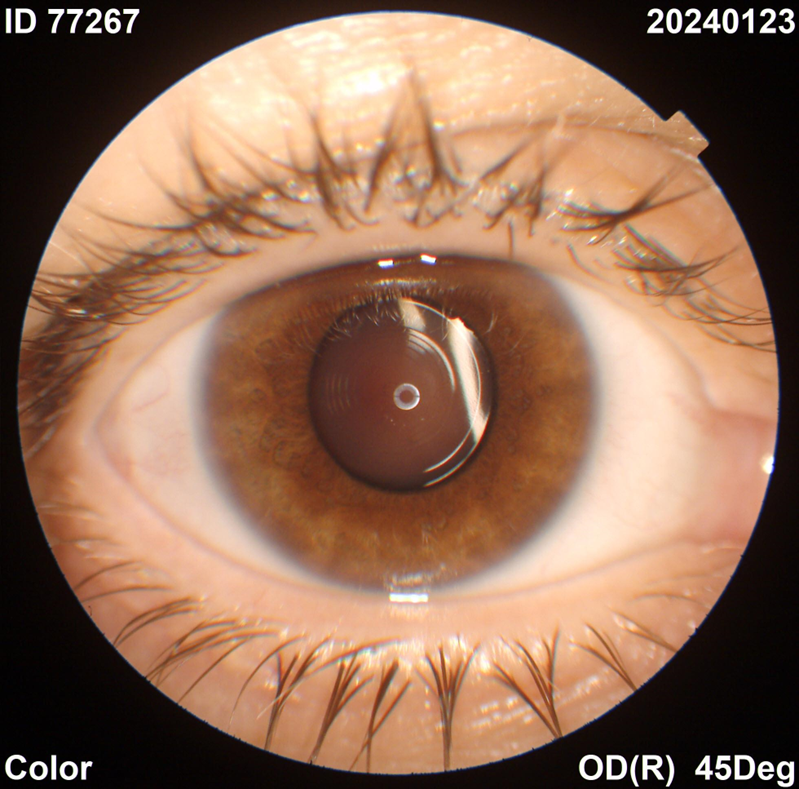 Глаз с факичной ИОЛ