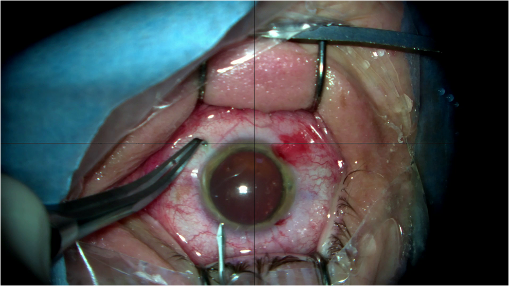 Имплантация факичной пресбиопической ИОЛ