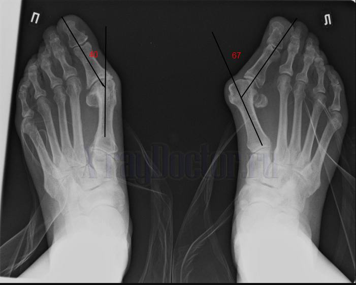 Про плоскостопие - 20