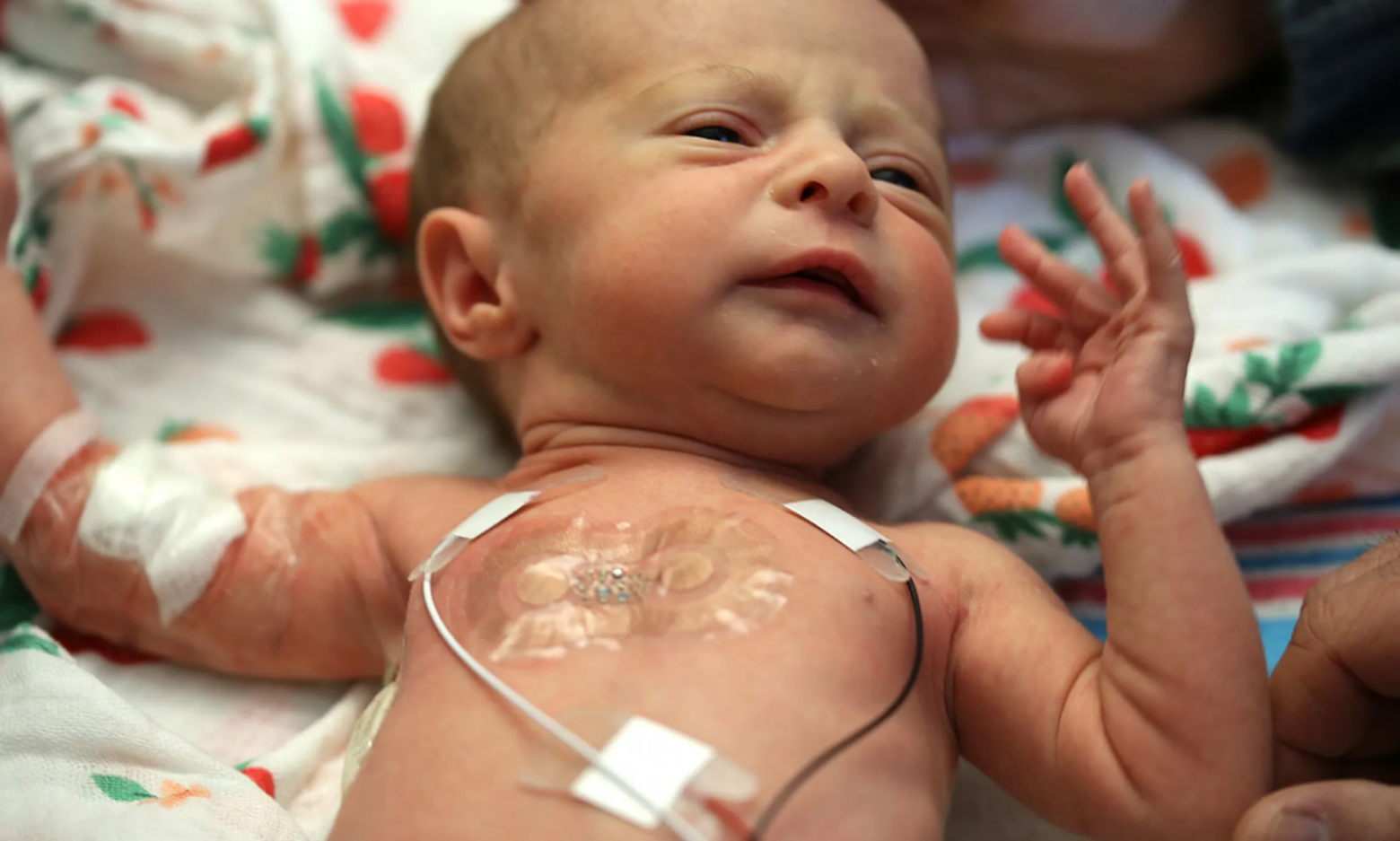 На груди малыша наклеен беспроводной пластырь, передающий частоту сердечных сокращений, температуру и уровень оксигенации крови. Рядом — старые дублирующие датчики с проводами