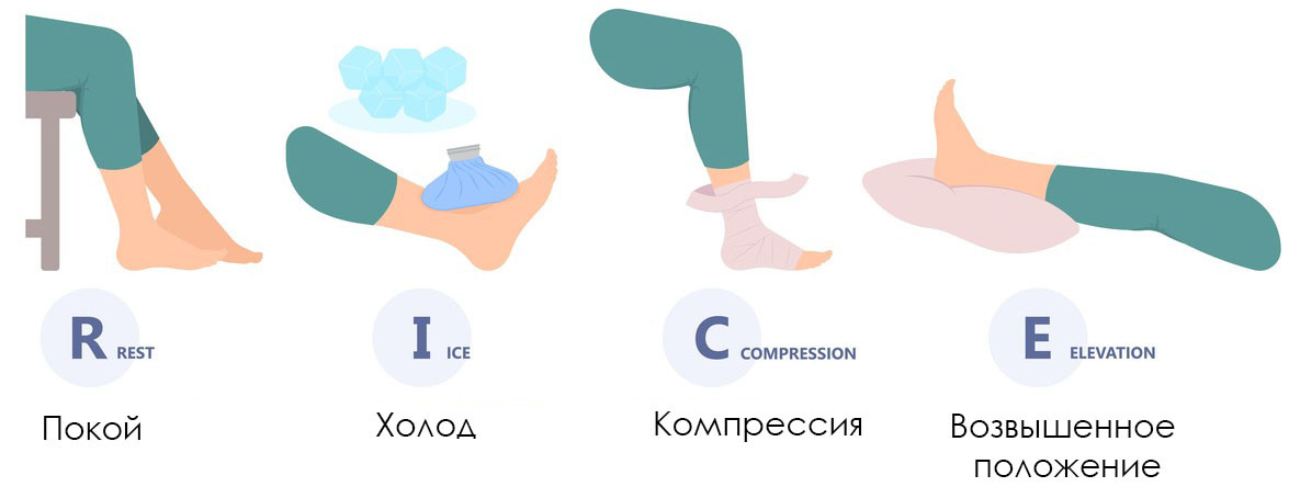 Покой. Нужно прекратить любую активность, чтобы защитить травмированную ногу от дополнительного повреждения. Холод. Ледяной компресс замедляет кровоснабжение и притупляет болевые рецепторы. Для него можно использовать лёд или любой продукт из морозильной камеры, завёрнутый в полотенце или ткань. Компресс прикладывают к травмированному участку не дольше 20 минут. Компрессия. Нужно использовать эластичный бинт, чтобы зафиксировать ногу. Повязка должна быть плотной, но не слишком тугой. Возвышенное положение. Чтобы уменьшить отёк, нужно расположить ногу выше уровня сердца. Для этого можно подложить под ногу подушки или валики.