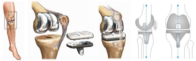 Схема замены коленного сустава