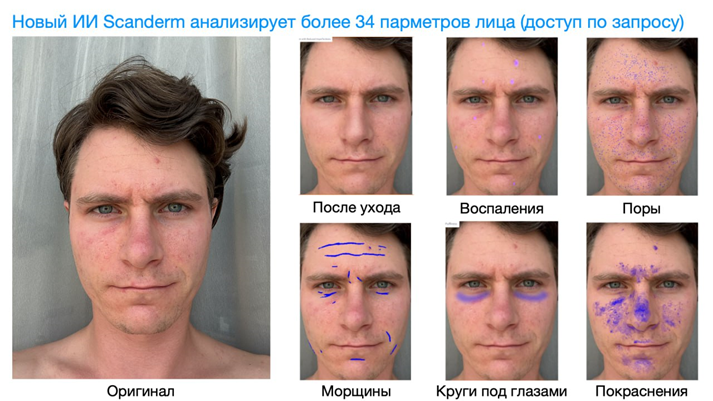 Евгений Соболев продемонстрировал на себе, как Scanderm указывает пользователю проблемные зоны на лице (фото из личного альбома Е. Соболева)  