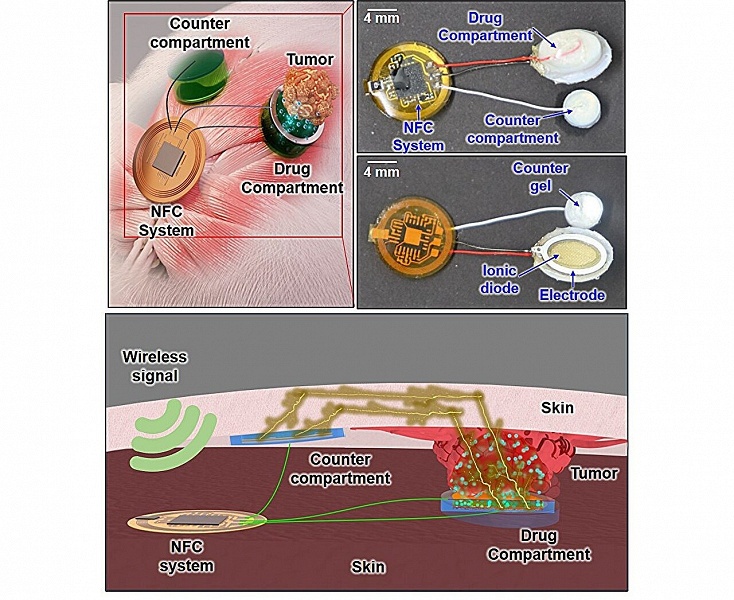 Имплантируемый чип с управлением через NFC сократил опухоль на 50% за 2 недели