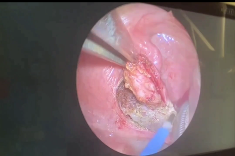 Удаление миндалин при помощи радиоволновой хирургии