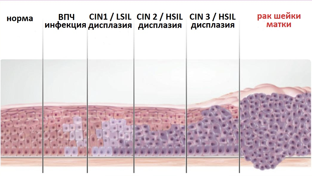 Риски ВПЧ: рак шейки матки и не только. Как этого избежать и почему мужчинам тоже нужно об этом знать? - 3