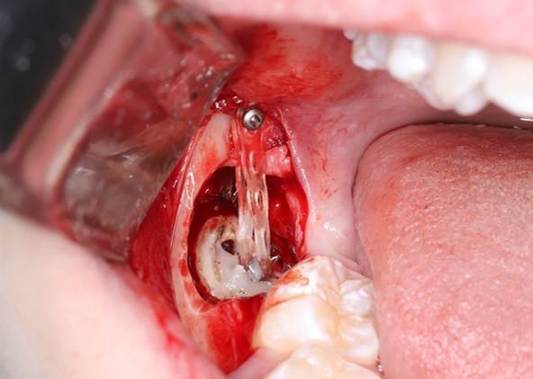 Самое дорогое удаление зубов мудрости - 10 Самое дорогое удаление зубов мудрости - 10