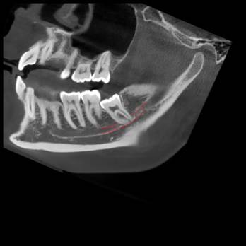 Самое дорогое удаление зубов мудрости - 11 Самое дорогое удаление зубов мудрости - 11