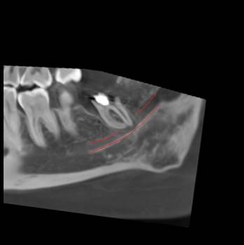 Самое дорогое удаление зубов мудрости - 12 Самое дорогое удаление зубов мудрости - 12