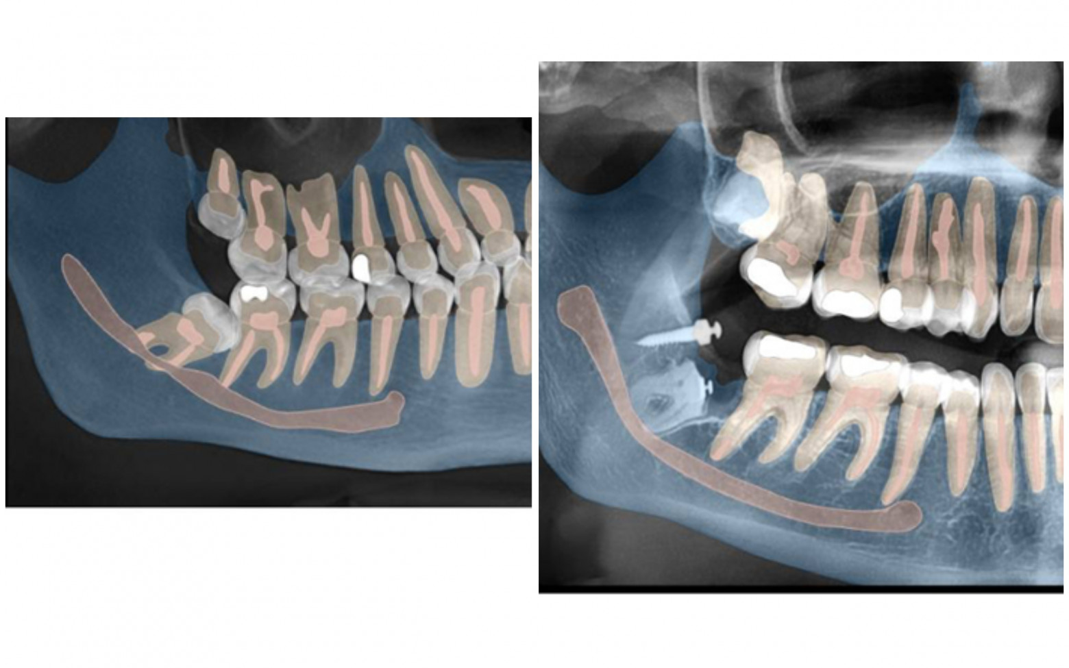 Самое дорогое удаление зубов мудрости - 13 Самое дорогое удаление зубов мудрости - 13