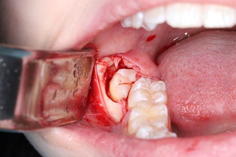 Самое дорогое удаление зубов мудрости - 5 Самое дорогое удаление зубов мудрости - 5