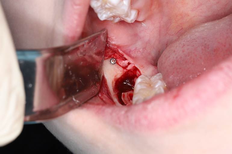 Самое дорогое удаление зубов мудрости - 7 Самое дорогое удаление зубов мудрости - 7