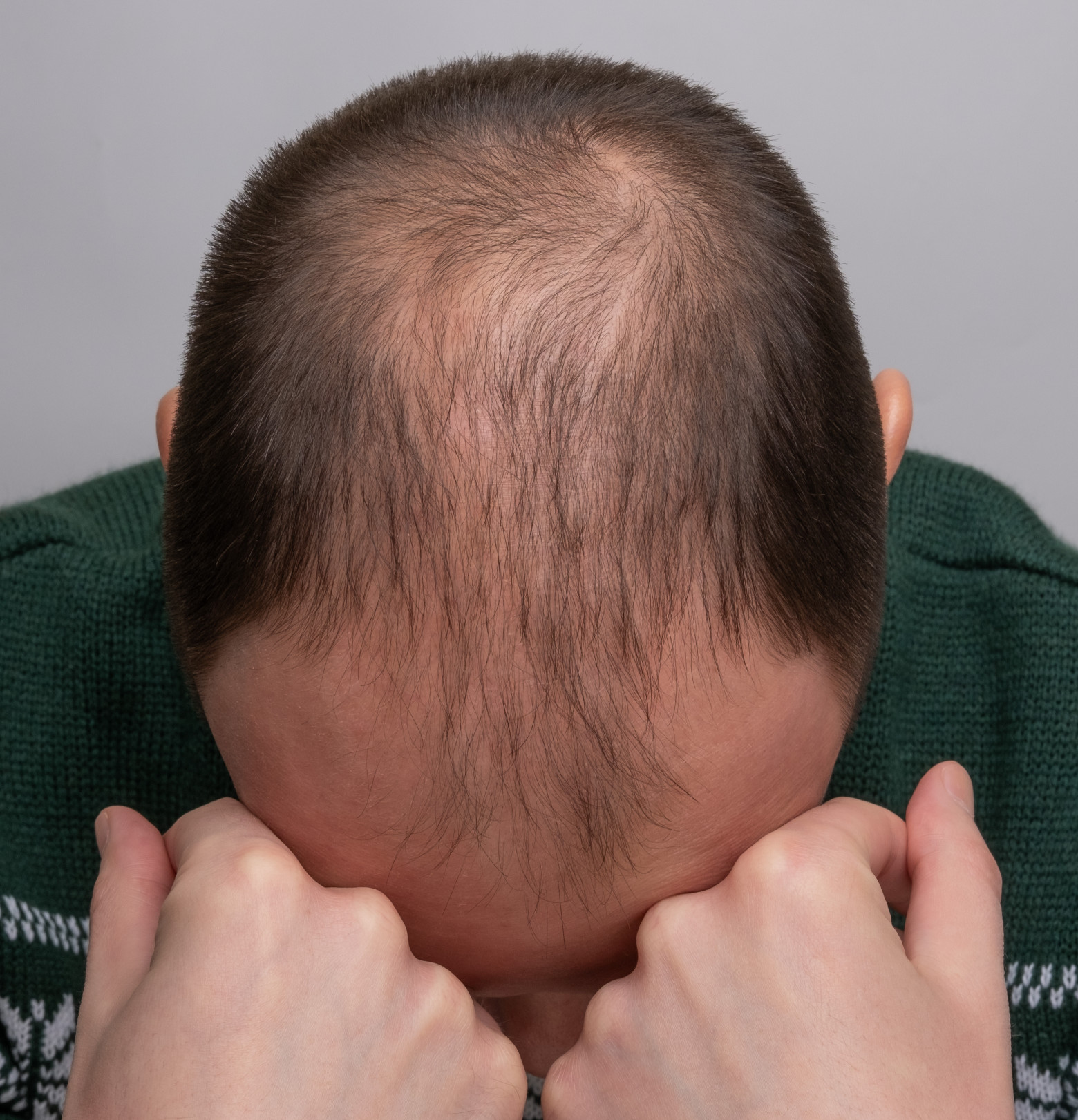 Если вы перешли на лысую сторону - 1