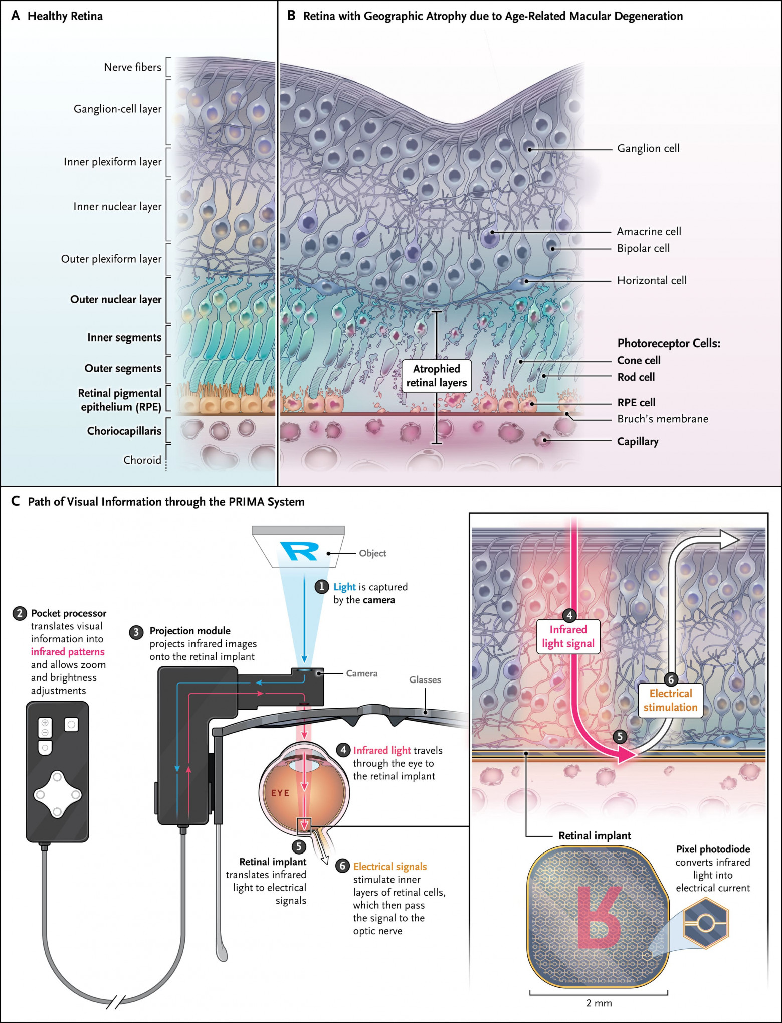 Видеть вновь: ИИ, глазной имплантат и очки дополненной реальности - 2 Видеть вновь: ИИ, глазной имплантат и очки дополненной реальности - 2