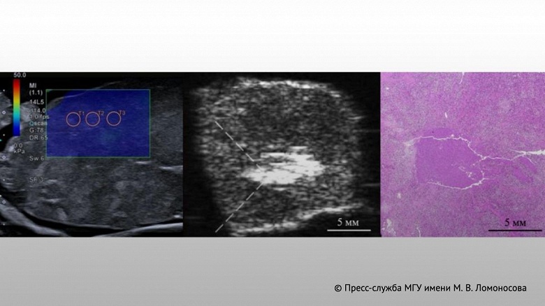 Российские ученые впервые разрушили агрессивную опухоль с помощью ультразвука - 1 Российские ученые впервые разрушили агрессивную опухоль с помощью ультразвука
