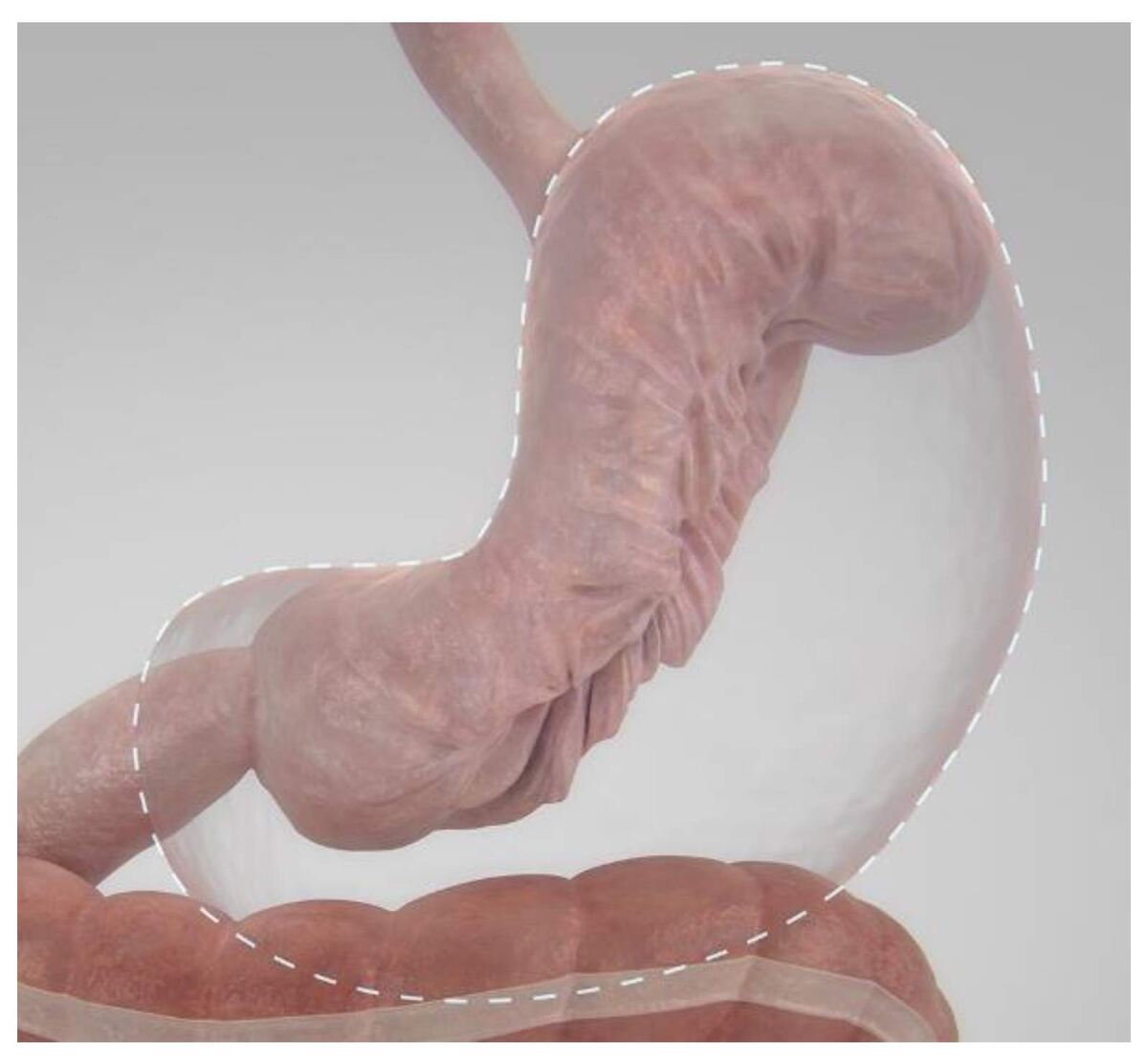 Так выглядит желудок после ESG