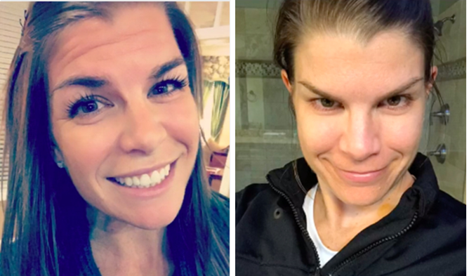 Почему ботокс больше не колют после того, как взломали синаптический перенос - 4