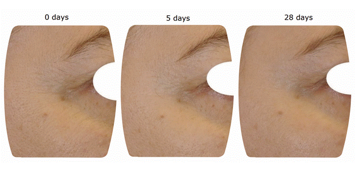 За 28 дней мышцы лица в состоянии покоя становятся на 11,1% более расслабленными