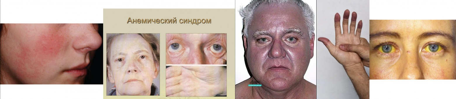 Слева направо: эритема, бледность, цианоз, желтуха