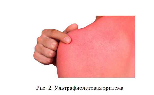 источник: https://kpfu.ru/staff_files/F1556951531/Erythema.pdf