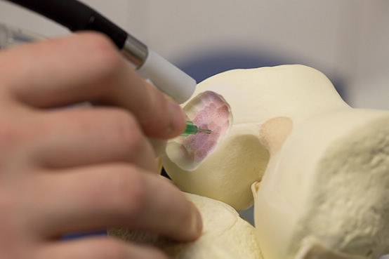Хирургический 3D принтер BioPen позволяет «печатать» ткани прямо в ходе операции