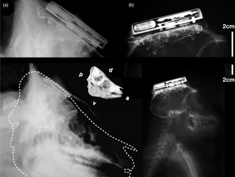 Первый беспроводной имплантируемый компьютерно мозговой интерфейс Первый беспроводной имплантируемый компьютерно мозговой интерфейс