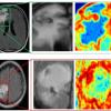 Компьютерная программа лучше врачей диагностирует рак мозга по снимкам МРТ