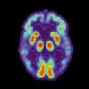 Искусственный интеллект научился находить болезнь Альцгеймера в мозге за 6 лет до диагноза