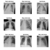 Ищем пневмонию на рентгеновских снимках с Fast.ai
