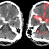 Исследователи натренировали нейросеть на поиск повреждений мозга