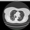 Модель для распознавания степени поражения лёгких на КТ: мы резко увеличили точность сортировки больных