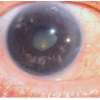 «Красивые глаза» как симптом болезни
