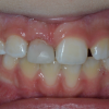 Как правильно собрать зубы в пакетик: реплантация выбитых зубов
